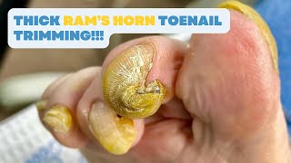 Thick RAM’S HORN TOENAIL Trimming [upl. by Rombert656]