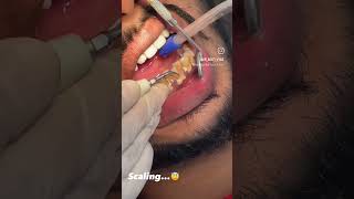 Pyorrhea scaling dato ki safai pyorrhea teethwhitening teethcleaning scaling smile halitosis [upl. by Diella]