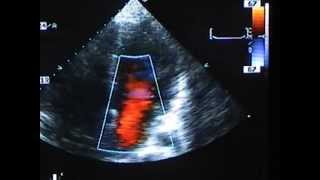 Severe Mitral Valve Prolapse [upl. by Darmit]