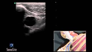 How To Ultrasound Guided Insertion of a Subclavian Vein Catheter 3D Video [upl. by Yrac]