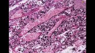 Histopathology Lymph nodeAnthracosis tuberculosis [upl. by Adnohryt428]