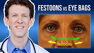 What Are Eye Festoons vs Lower Eyelid Bags [upl. by Pfaff]