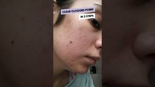 3 steps to clear cloggedpores [upl. by Gilbertine]