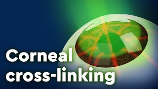 Corneal Collagen Crosslinking and Keratoconus Treatment [upl. by Azil]