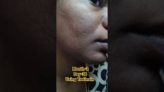 Day36 Using Tretinoin viralvideo tretinoin skincare shorts youtubeshorts [upl. by Eentruok]