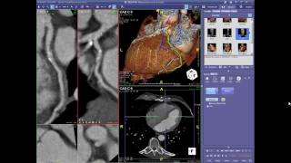 Cardiac CT Angiography Case Review Webinar 101911 [upl. by Teeter343]