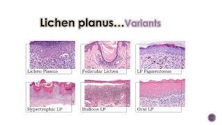 7 Lichenoid Dermatoses 1 [upl. by Adirehs781]