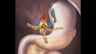 EUS CELIAC PLEXUS NEUROLYSIS [upl. by Bard]