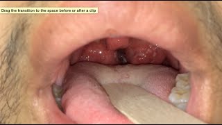 severe sore throat [upl. by Patti985]