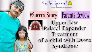 Palatal Expander Treatment Of A Child With Down Syndrome  Success Story✨ [upl. by Neall757]