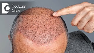 Side effects of Hair Transplant  Dr Vivekanand Bhat [upl. by Katherine]