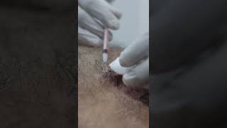 ILS Injection for Keloid Treatment get rid of Keloids with Skinaa Clinic shorts viralskinaclinic [upl. by Yromas]