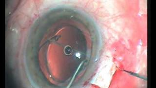 scleral fixation of dislocated iolwmv [upl. by Gruchot]