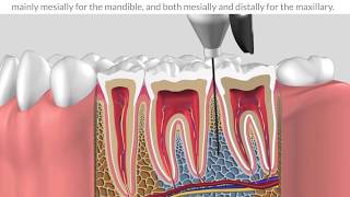 Protocole intraosseous anesthesia [upl. by Benedict]