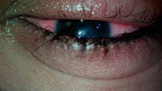 PUNCTAL PLUG FOR SEVERE DRY EYES [upl. by Chlo]