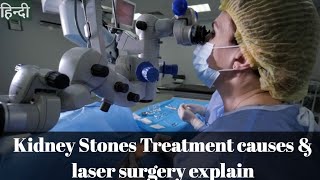 Kidney Stones Treatment causes and laser surgery explain in hindi [upl. by Brok712]