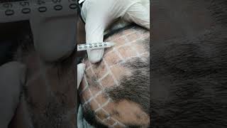 Demo19 Intralesional triamcinolone for alopecia areata [upl. by Tolmach232]