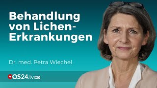 LichenErkrankungen Ist die Behandlung mit Cortisonsalbe genug  Dr med Petra Wiechel  QS24 [upl. by Lilithe366]