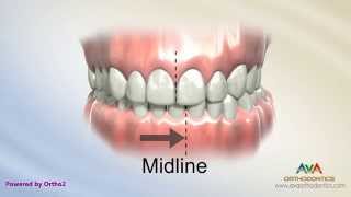 Orthodontic Treatment for Narrow Upper Jaw with Functional Shift  Expander or Spacer [upl. by Horvitz]