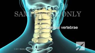 Lumbar Laminectomy [upl. by Hachman332]