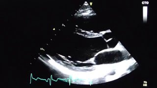 Parasternal long axis view PLAX [upl. by Hodges431]