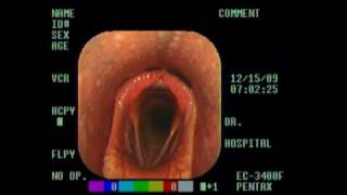 Normal Larynx mpg [upl. by Eseenaj]