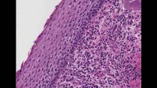 Histopathology Cervix  Squamous cell carcinoma [upl. by Kelcy880]