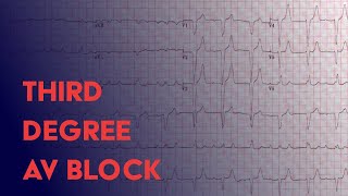 Third Degree Complete Heart Block  EKG ECG Interpretation [upl. by Sarette]