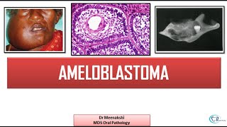 Ameloblastoma  Benign Odontogenic Tumor [upl. by Nyledam228]