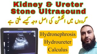 Kidney stone  ureter stone  Hydronephrosis  Hydroureter  Dr Qazi Fahim Shezad [upl. by Ettenil]