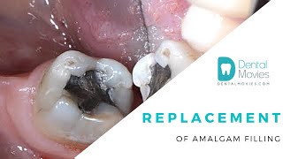 Replacement of amalgam filling [upl. by Meurer102]