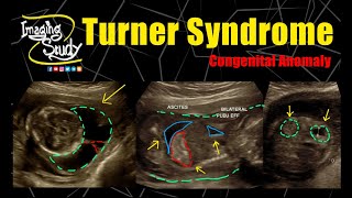 Turner Syndrome  45X  Monosomy X  Ultrasound  Anomaly  Case 276 [upl. by Yesnyl]