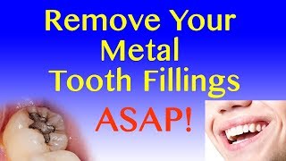 Replace Amalgam Fillings As soon as you can Your HEALTH is more important than the cost [upl. by Lenna]