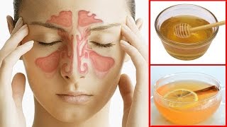 How To Get Rid of a Sinus Headache Fast  Sinus Pressure Relief [upl. by Analat]