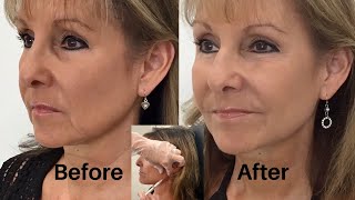 How to Get Rid of Jowls with Dermal Fillers Step 2 [upl. by Hsetih]