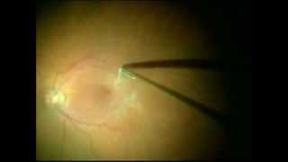 Epiretinal membrane peel [upl. by Anyotal]