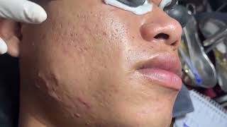 Acne Treatment Huong Da Nang601  2024 blackheads [upl. by Bellamy]