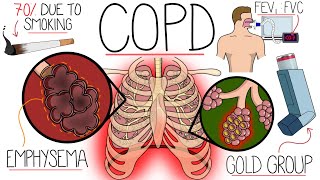 Understanding Chronic Obstructive Pulmonary Disease COPD Explained Clearly [upl. by Cornelius]