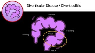 Diverticular Disease and Diverticulitis [upl. by Anerbas320]