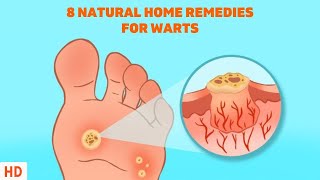 8 Surprising Home Remedies for Warts  Get Rid of Them Naturally [upl. by Largent732]