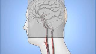 Diagnostic Cerebral Angiography [upl. by Mazel78]