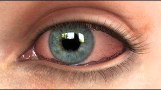 Conjunctivochalasis CCH Dry Eye Animation [upl. by Noivaz491]