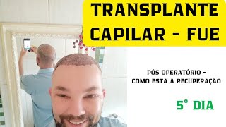 TRANSPLANTE CAPILAR  FUE 5° DIA PÓS OPERATÓRIO [upl. by Ettevol368]