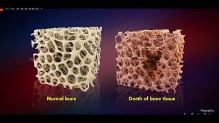 Avascular Necrosis  Core Decompression [upl. by Notwen]