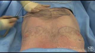 Ultrasonic liposuction of a mans chest and abdomen [upl. by Morril]