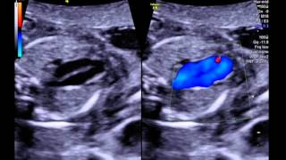 Double outlet right ventricle with an uncommitted VSD and normal great artery connections 3VT [upl. by Mikeb]