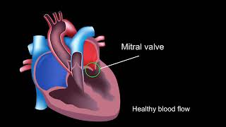 Physiology of rheumatic heart disease [upl. by Demmer]