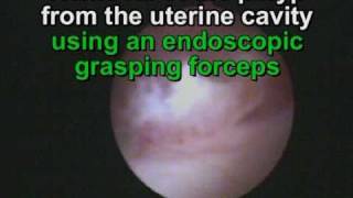 Removal of the polyp from the uterine cavity Grasping forceps [upl. by Jannel]