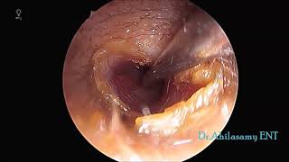 Myringotomy Grommet in 3yrs kid for Glue ear  OME [upl. by Dierdre]