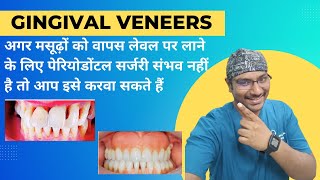 Dr RudraGingival Veneer मसूड़ों के अलग होने के कारण दांतों के प्रदर्शन को छिपाने का एक अनूठा तरीका [upl. by Dlareme449]